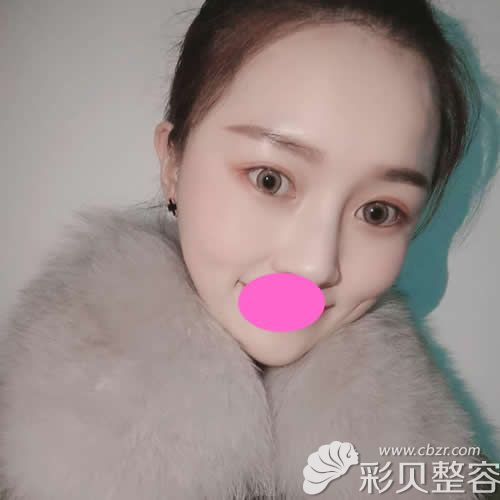 我找蚌埠美萊塢張迪醫(yī)生割7mm雙眼皮+開眼角術后2個月效果