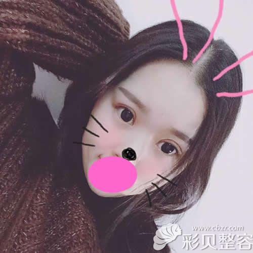 我找蚌埠美萊塢張迪醫(yī)生割7mm雙眼皮+開眼角術后第15天