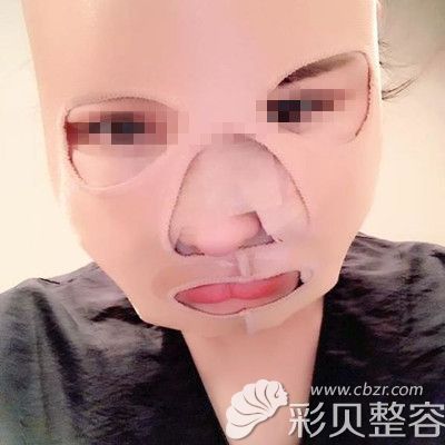 韓國迪美麗做面部吸脂+魔力V線條手術(shù)術(shù)后當(dāng)天