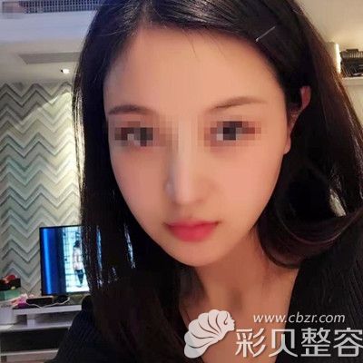 韓國迪美麗做面部吸脂+魔力V線條手術(shù)術(shù)后一個(gè)月