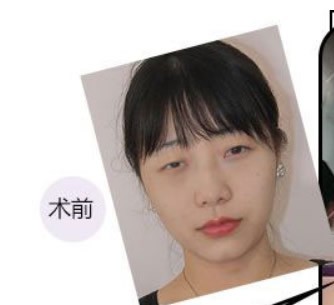圖片記錄我在遵義韓美整形做全切雙眼皮1個(gè)月恢復(fù)過(guò)程