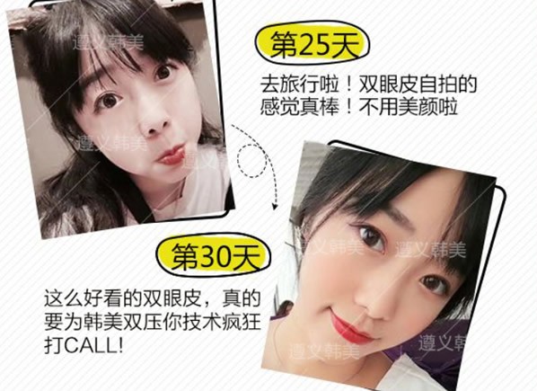 圖片記錄我在遵義韓美整形做全切雙眼皮1個(gè)月恢復(fù)過(guò)程