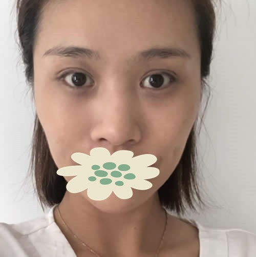 展示我在內(nèi)蒙古永泰做的硅膠隆鼻效果 自己很滿意