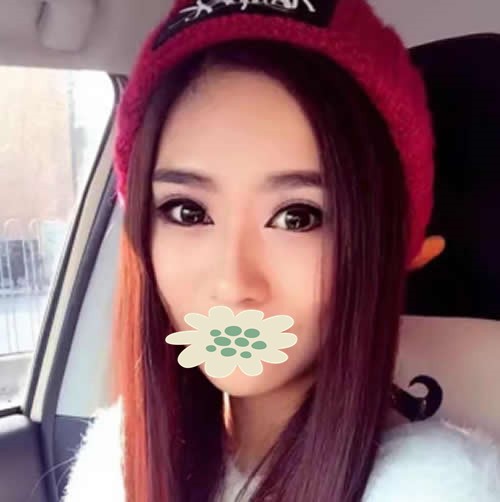 展示我在內(nèi)蒙古永泰做的硅膠隆鼻效果 自己很滿意