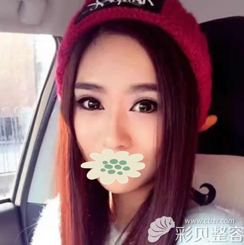 做完鼻子40天后效果圖