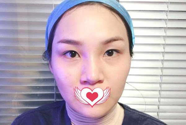 找樂清顧得美整周景和做全切雙眼皮+開眼角,比天生的還自然