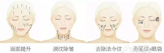 在面部這些部位中可以做埋線(xiàn)提升