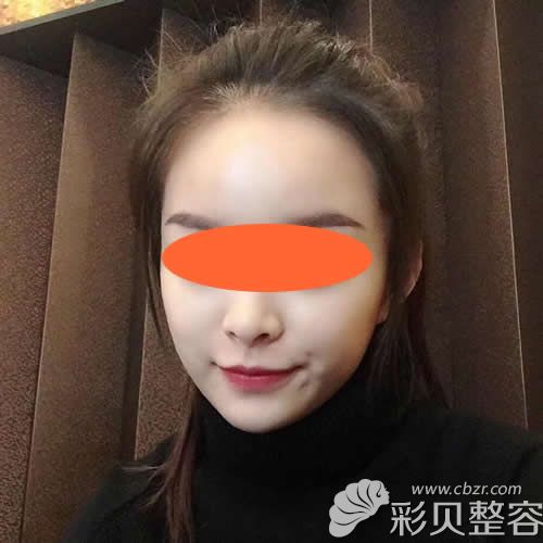 找深圳美加做自體肋骨隆鼻術(shù)后第24天