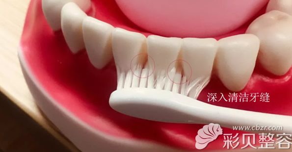 刷牙時(shí)深度清潔牙縫可以預(yù)防牙周炎 刷牙時(shí)深度清潔牙縫可以預(yù)防牙周炎