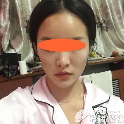 找深圳美加美做自體肋骨隆鼻術(shù)后第7天
