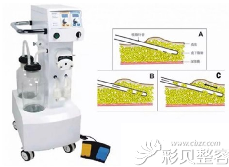 負(fù)壓吸脂的手術(shù)方式