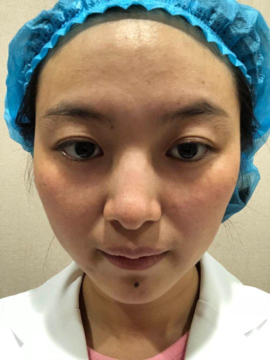 不需要恢復期的激光瘦臉溶脂