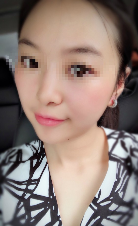 不需要恢復期的激光瘦臉溶脂