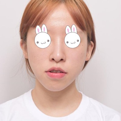 分享我在韓國EU做的雙鄂手術(shù)改善凸嘴后的大變身