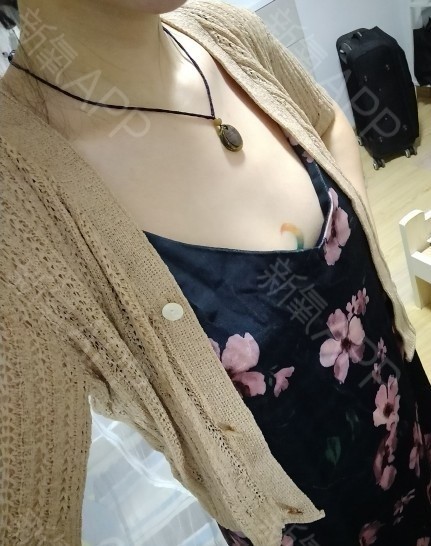 假體隆胸