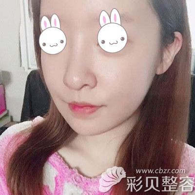 韓國(guó)EU頜面輪廓整形外科做雙鄂手術(shù)術(shù)后半個(gè)月