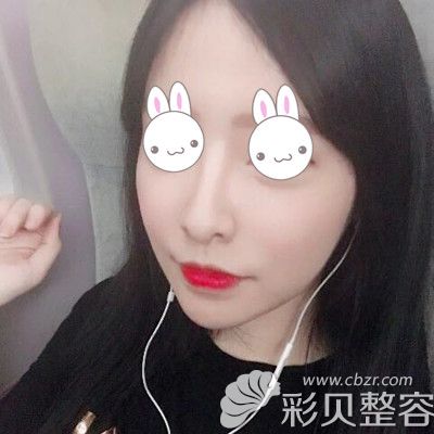 韓國(guó)EU頜面輪廓整形外科做雙鄂手術(shù)術(shù)后兩個(gè)月