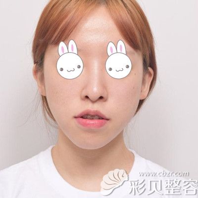 韓國(guó)EU頜面輪廓整形外科做雙鄂手術(shù)術(shù)前照