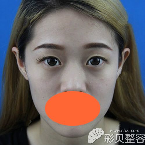 找南京華韓奇致章宏偉割雙眼皮+開眼角術(shù)前