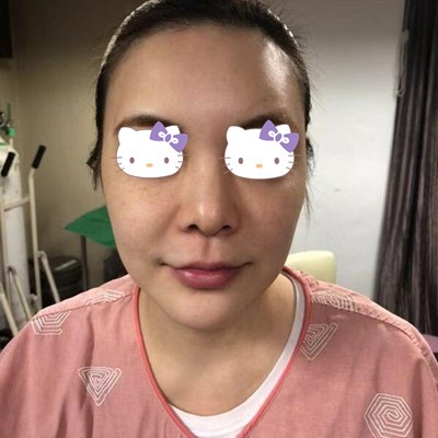 來(lái)看看我在韓國(guó)Artline整形醫(yī)院做的埋線提升效果怎么樣
