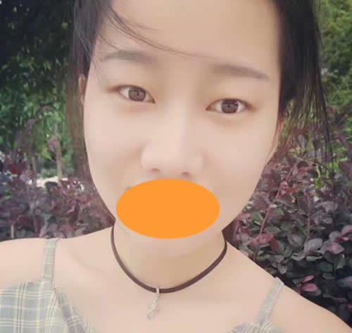 展示我在長沙華韓華美做雙眼皮+耳軟骨隆鼻40天恢復(fù)過程圖