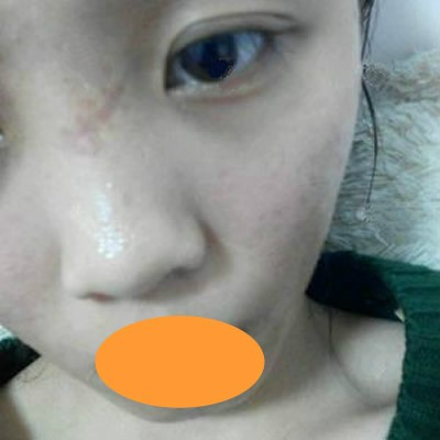 來瞧我找上海虹橋醫(yī)院單興柱做離子靶向祛疤30天效果怎么樣