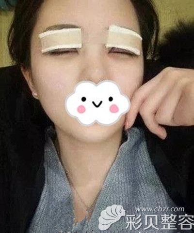 韓國摩茲MODS做雙眼皮手術術后當天