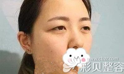 韓國摩茲MODS做雙眼皮手術術前照
