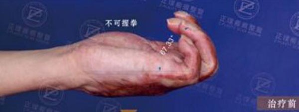 了解了武漢正璞疤痕修復價格后,找周宏礽做祛疤效果很自然