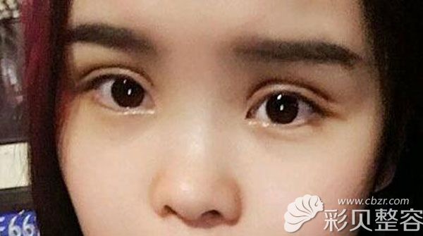 全切雙眼皮第7天拆線，稍有腫脹