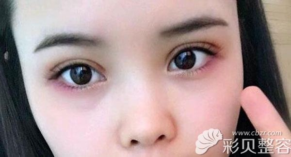 全切雙眼皮40天感覺(jué)有點(diǎn)歐式風(fēng)格