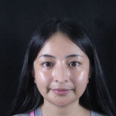常德側(cè)顏神器秒殺神器 —“凱爾美斯膨體隆下巴”了解一下