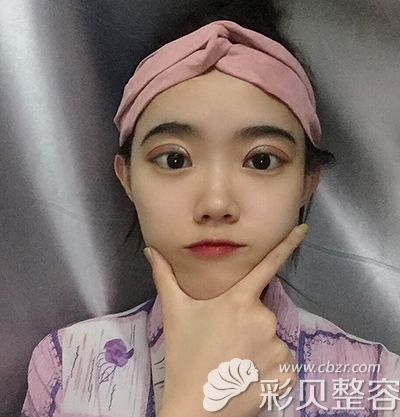 術(shù)后15天.JPG