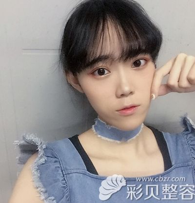 術(shù)后30天.JPG