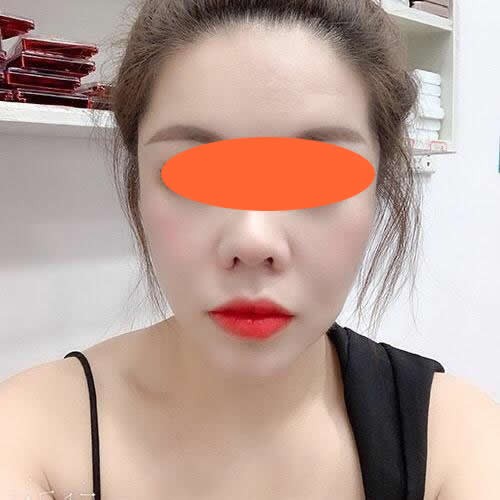 實(shí)名夸贊韓國菲斯萊茵李真秀院長,講述我做雙鄂手術(shù)的經(jīng)歷