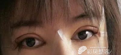 找西安葉子王愛武割泫雅同款雙眼皮術(shù)后第3天