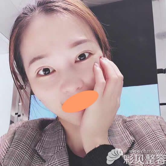 找長(zhǎng)沙臉博士唐毅做開(kāi)扇式雙眼皮術(shù)后第31天
