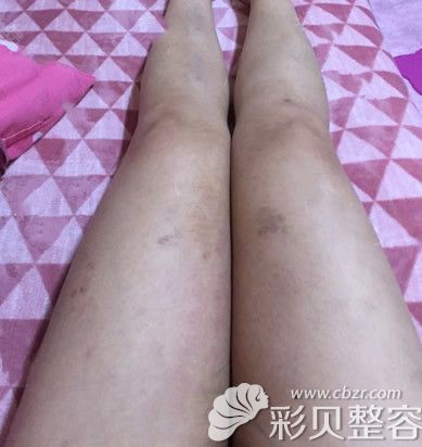 韓國安宰賢腿部抽脂一個月效果圖 韓國安宰賢腿部抽脂一個月效果圖