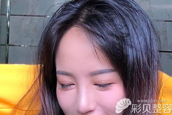 切開(kāi)雙眼皮第20天寬度適中、弧度很自然