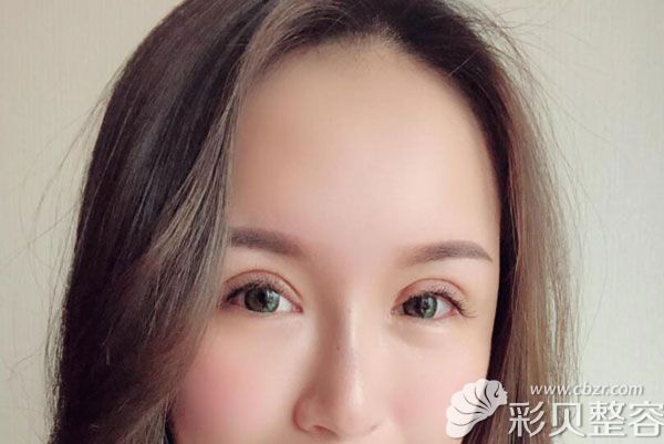 雙眼皮第7天拆線(xiàn)