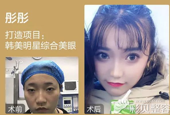 遵義韓美于建濤眼綜合整形案例 遵義韓美于建濤眼綜合整形案例