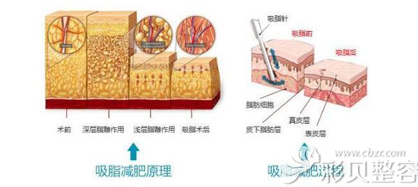 吸脂原理及過(guò)程