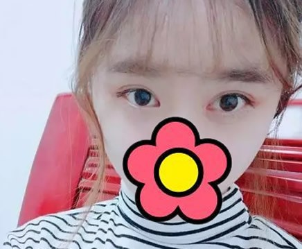 求評(píng)價(jià):看臺(tái)州恩璨整形汪堡壘給我全切雙眼皮7mm效果好看不