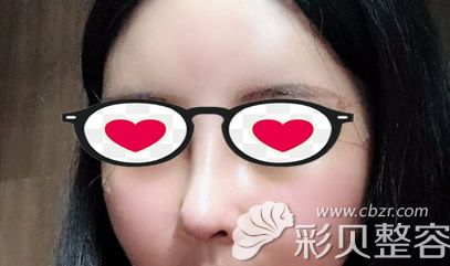 鼻綜合隆鼻第七天效果圖