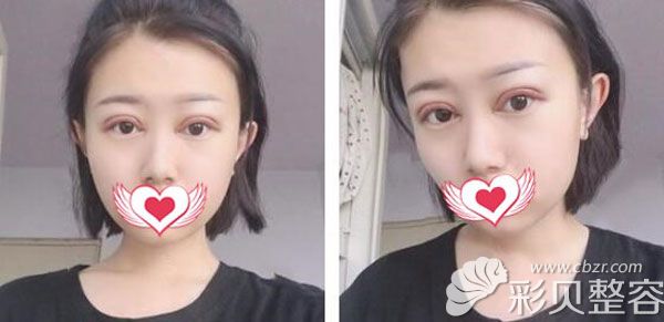 割雙眼皮第3天腫脹以為手術(shù)失敗了