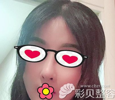 牛勇敢鼻綜合隆鼻修復(fù)三個(gè)月效果