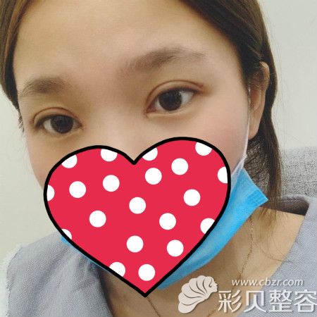 找池州麗美整形周著祖做雙眼皮術(shù)后20天