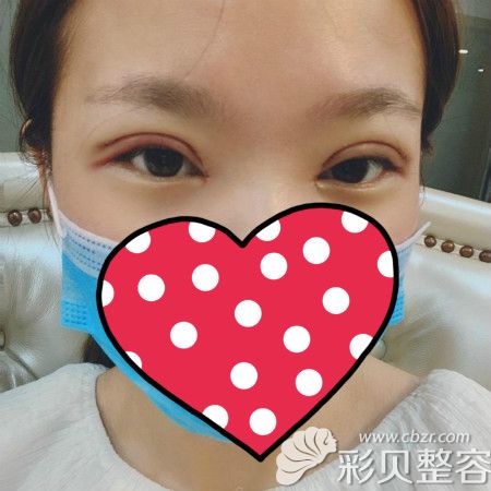 找池州麗美整形周著祖做雙眼皮術(shù)后第3天