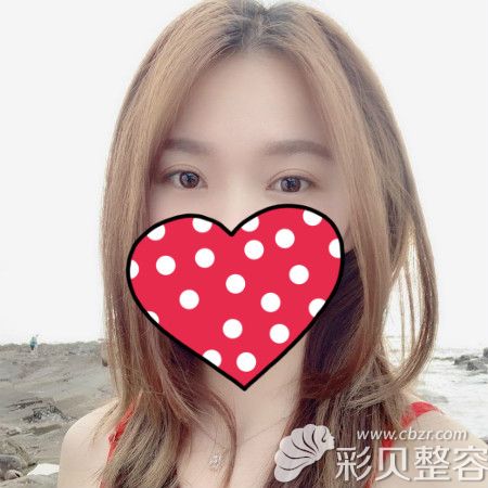 找池州麗美整形周著祖做雙眼皮術(shù)后2個月美拍