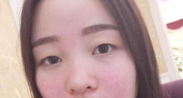 海南藍(lán)顏慧李潤琴切開雙眼皮把我單眼皮和腫眼泡全解決了